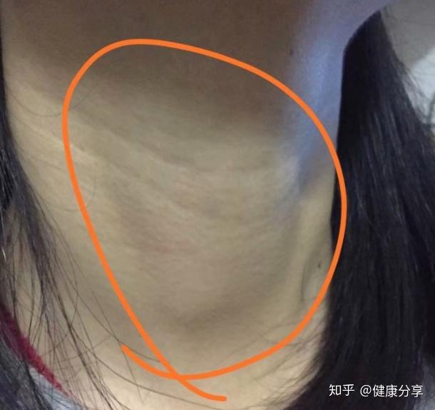 得了桥本氏甲状腺炎和甲状腺结节没有治疗方法只有等么? - 知乎