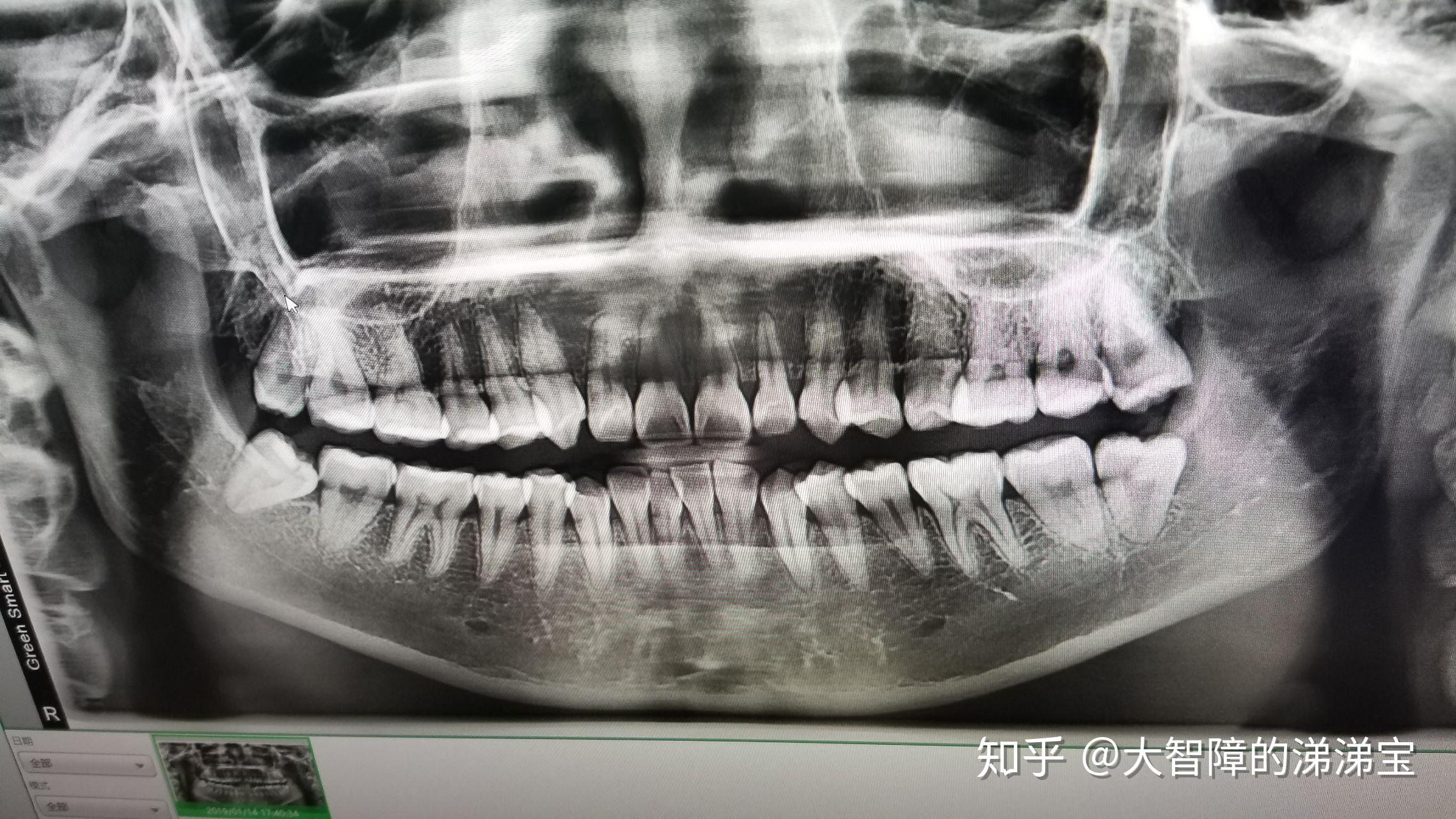 智齿长得很好即正位不痛是什么体验