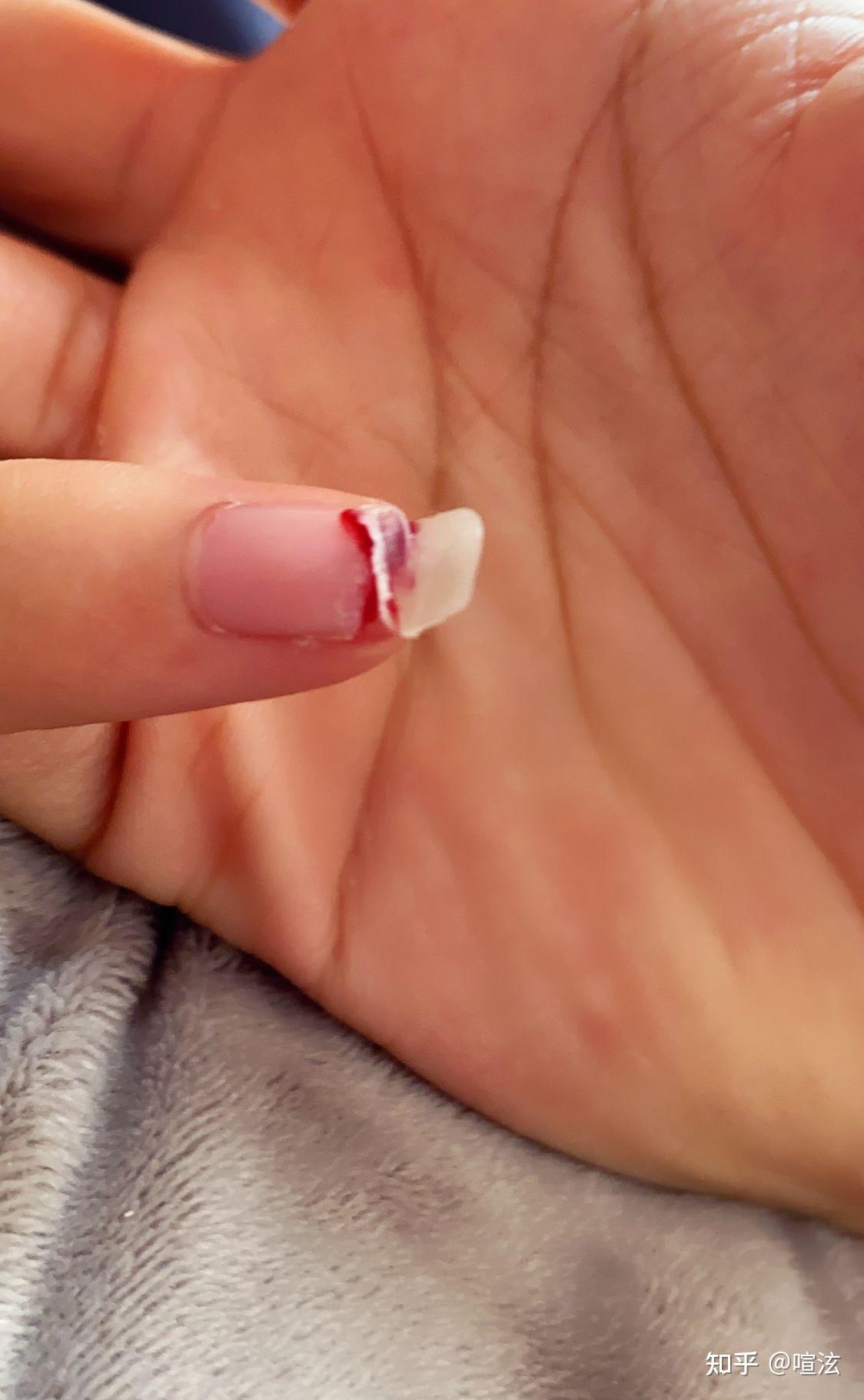 指甲断了如何处理? - 知乎