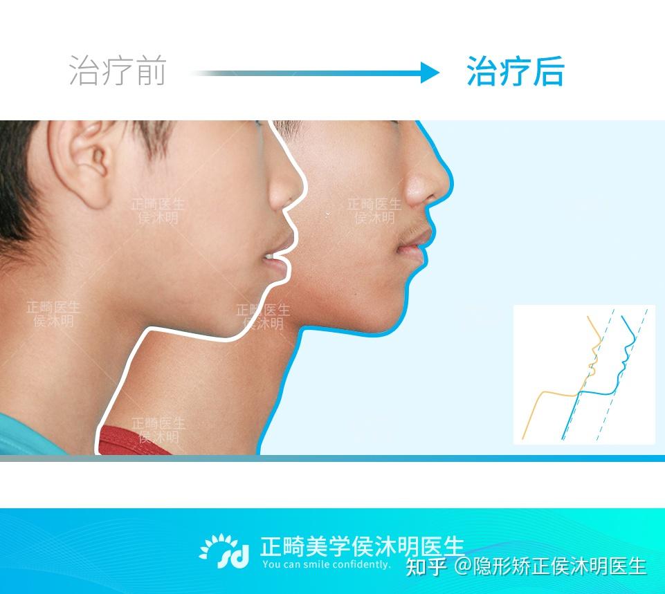口呼吸面容(腺样体面容) 是否没得改善?