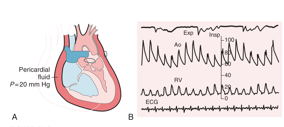 右心衰为什么会出现奇脉