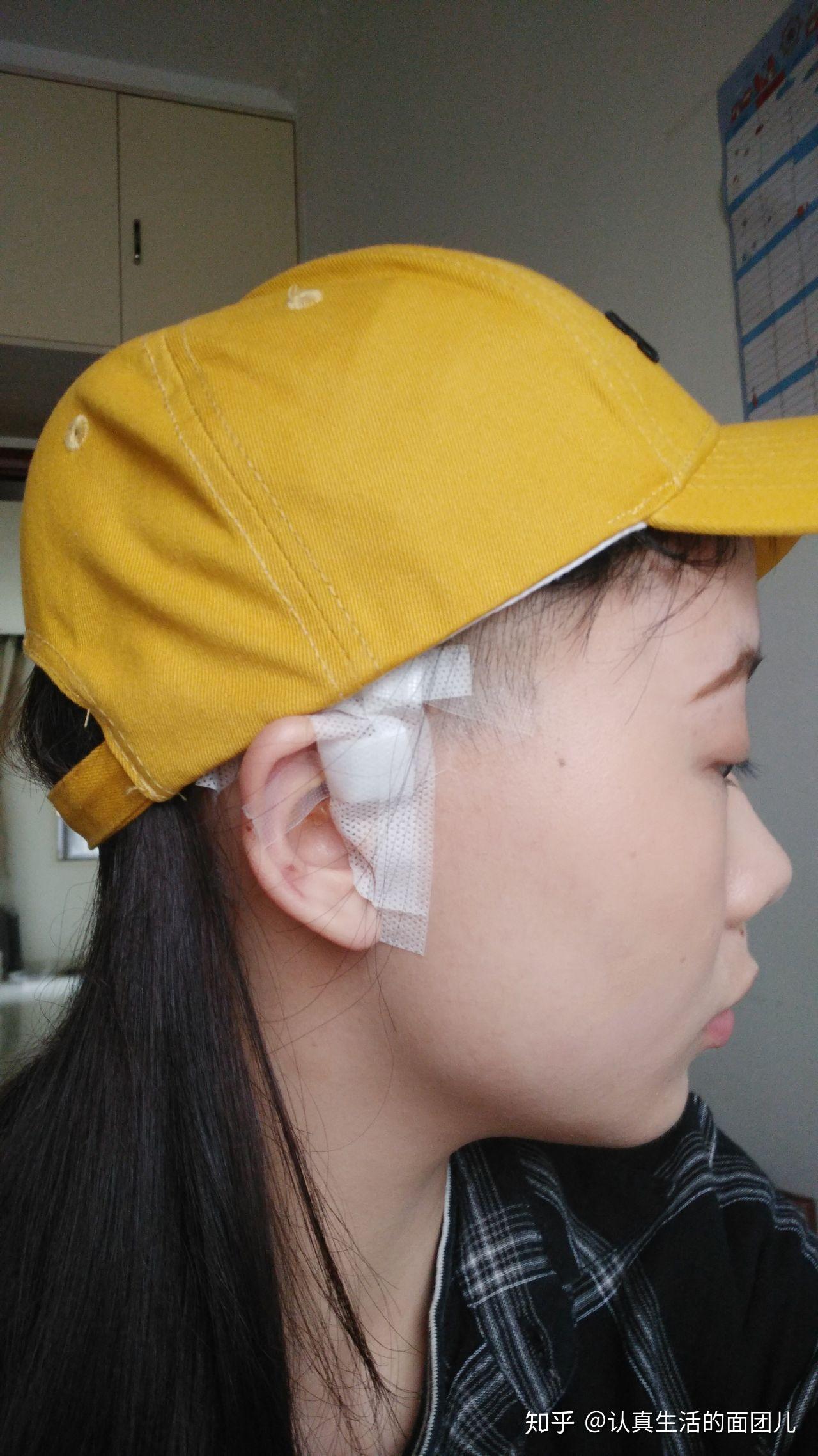 患有先天性耳前瘘管是一种怎样的体验