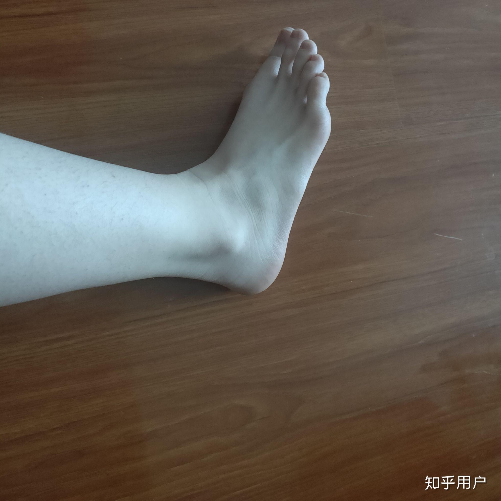 什么样的脚踝叫做没有脚踝? - 知乎