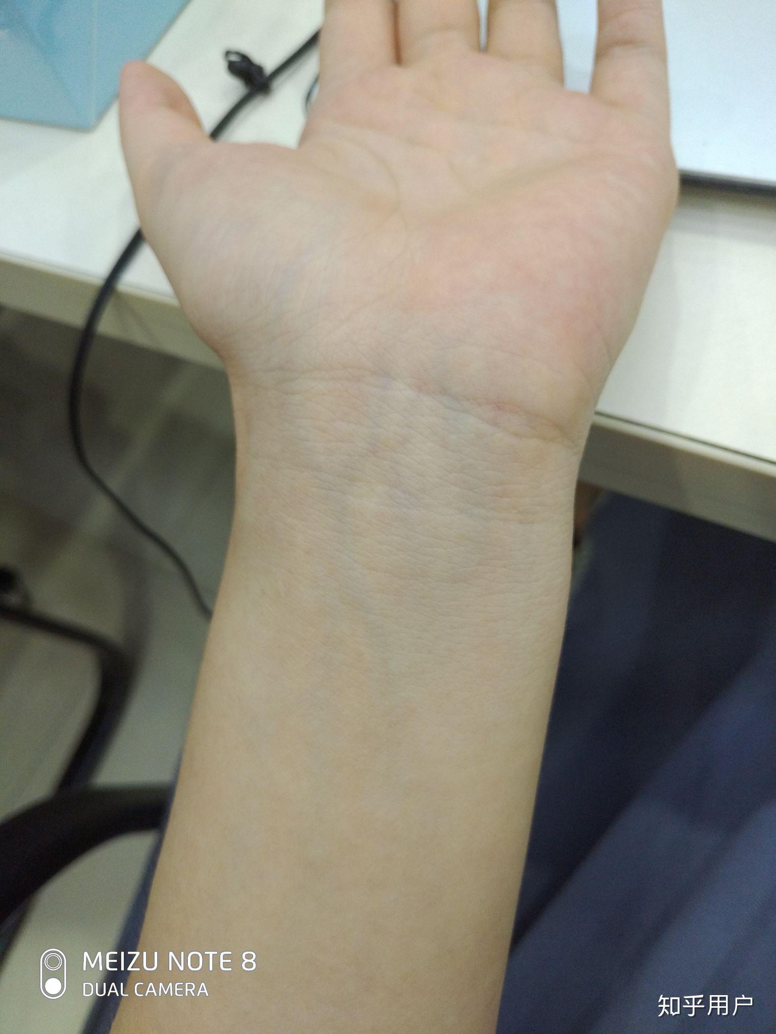 手腕上静脉颜色很明显是身体有什么病症的原因吗