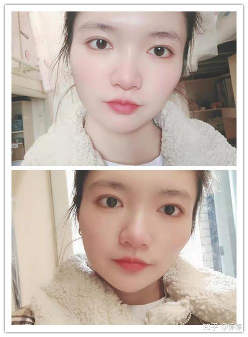 埋线双眼皮恢复期一个月 v2-61a21aa7a27cf5473584c469450a84b5_r.jpg