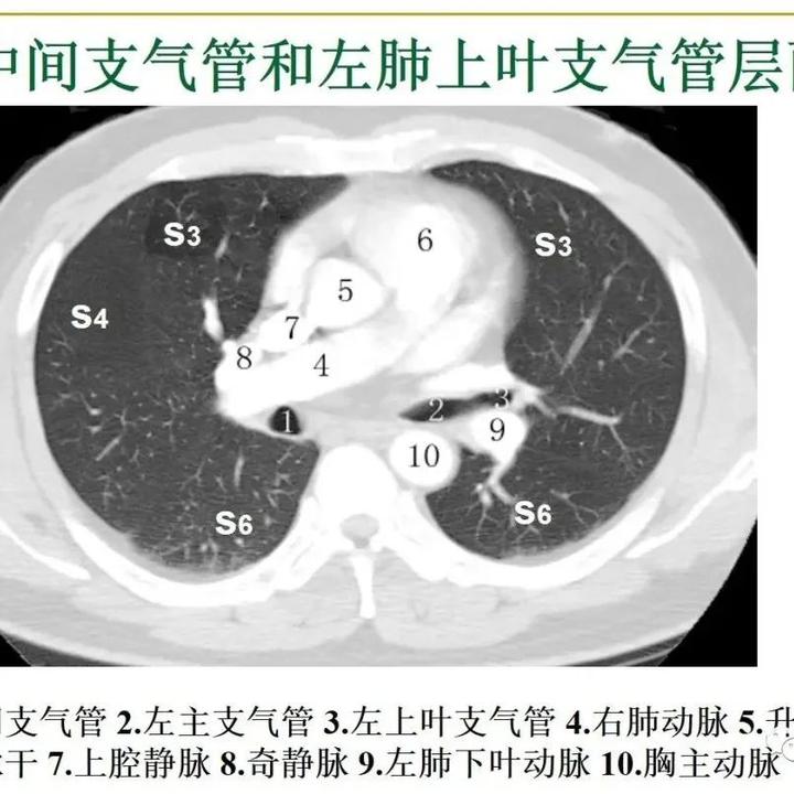 胸部CT读片技巧汇总 - 知乎