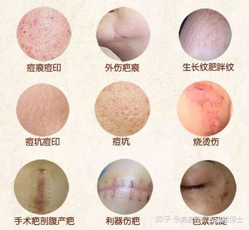 胳膊肘的疤痕能去掉吗