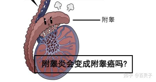 附睾炎会变成附睾癌吗? - 知乎