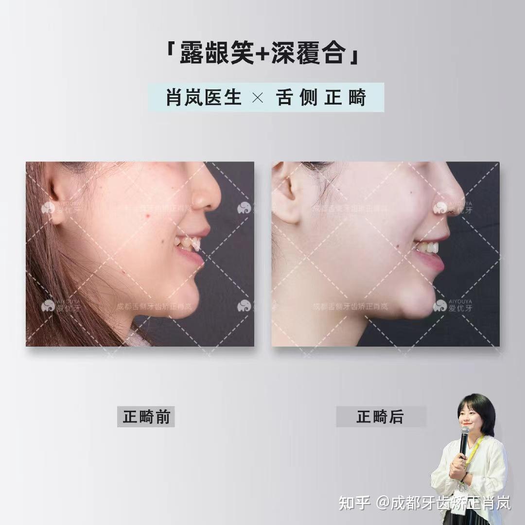 舌侧矫正可以解决哪些牙齿问题? - 知乎