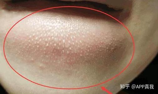 下巴反复长闭口,一大排密密麻麻还凸起怎么办? - 知乎