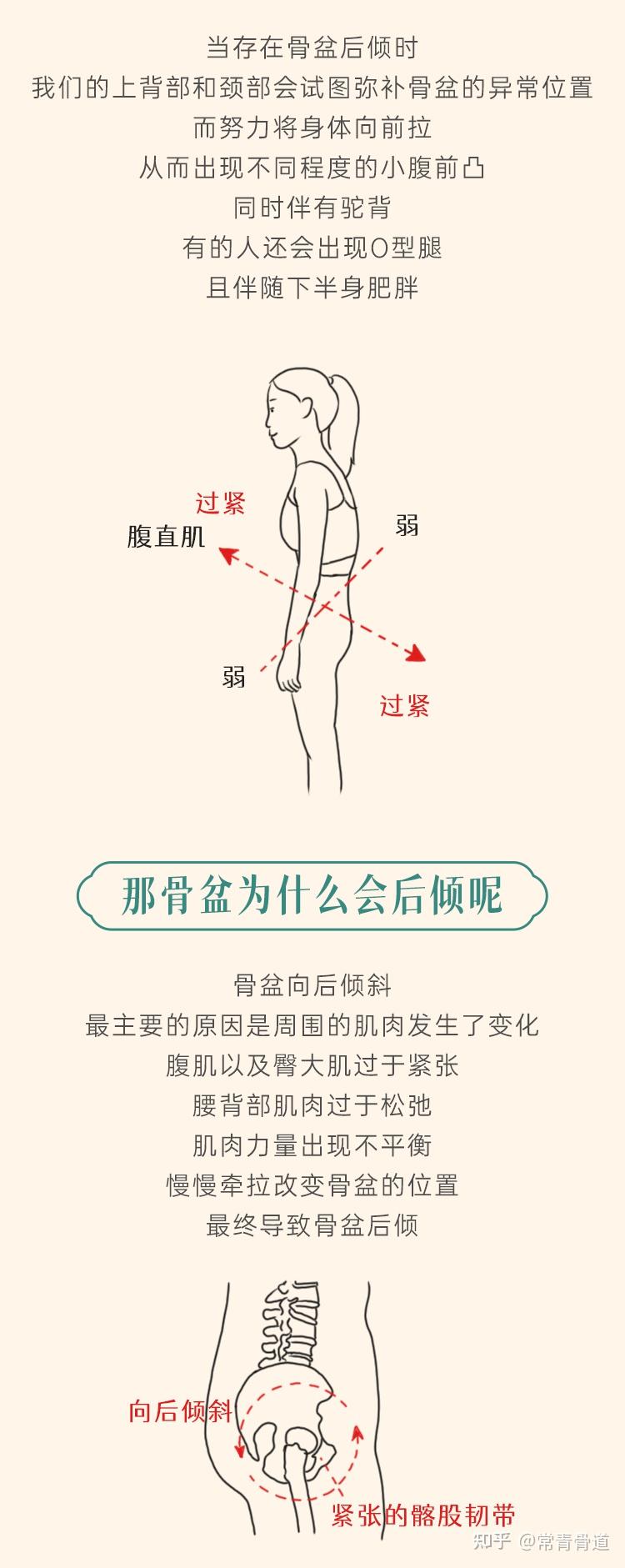 单侧腰痛(竖脊肌)的问题,骨盆后倾! - 知乎
