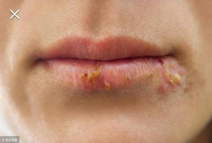 嘴唇疱疹可以用牙膏涂吗? - 知乎
