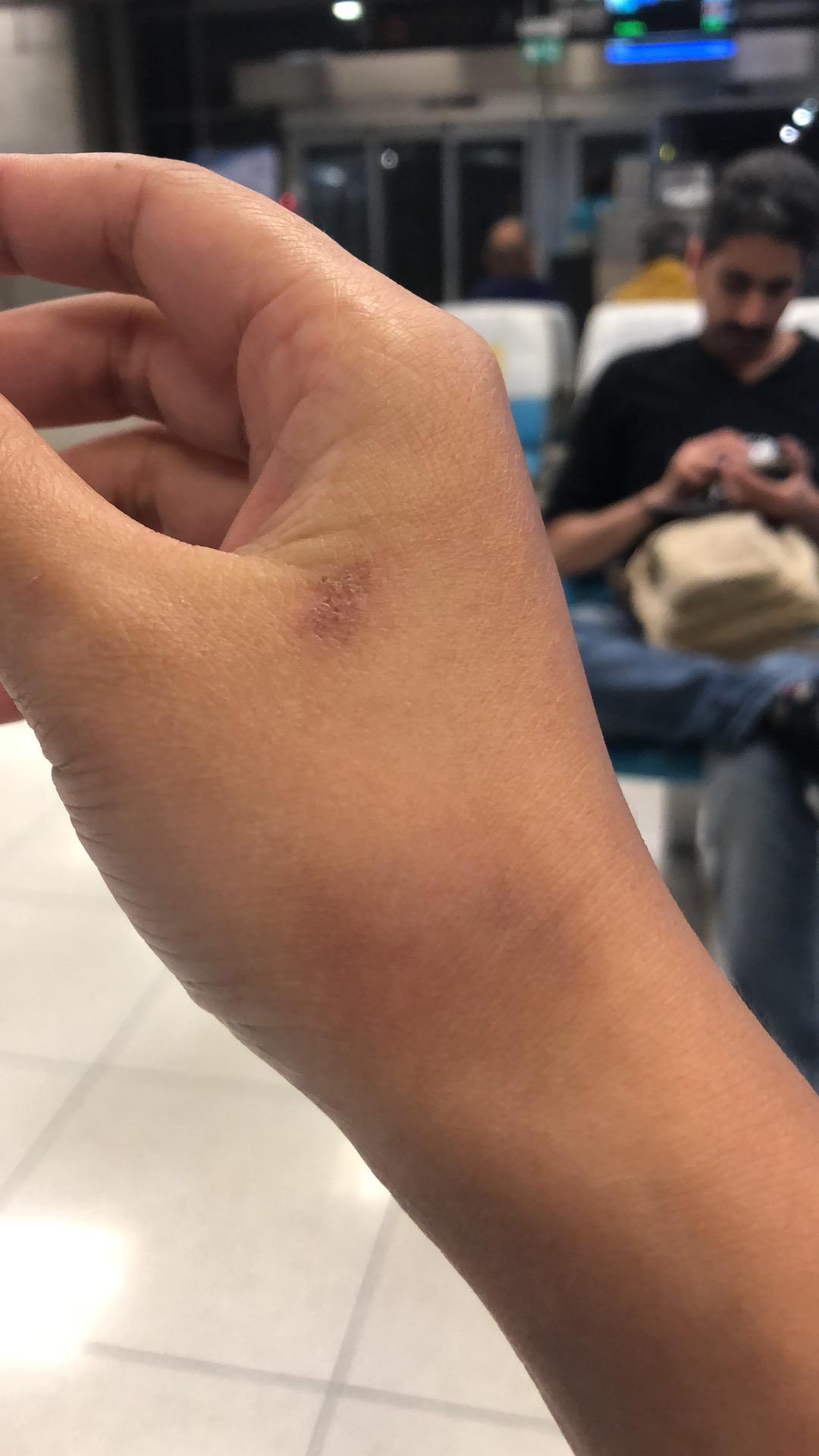 疤痕体质,被蚊虫叮咬或者破皮就会留疤怎么办?