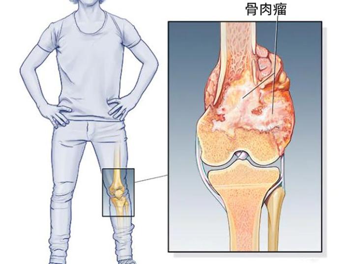 女性骨癌一般是哪里疼图片