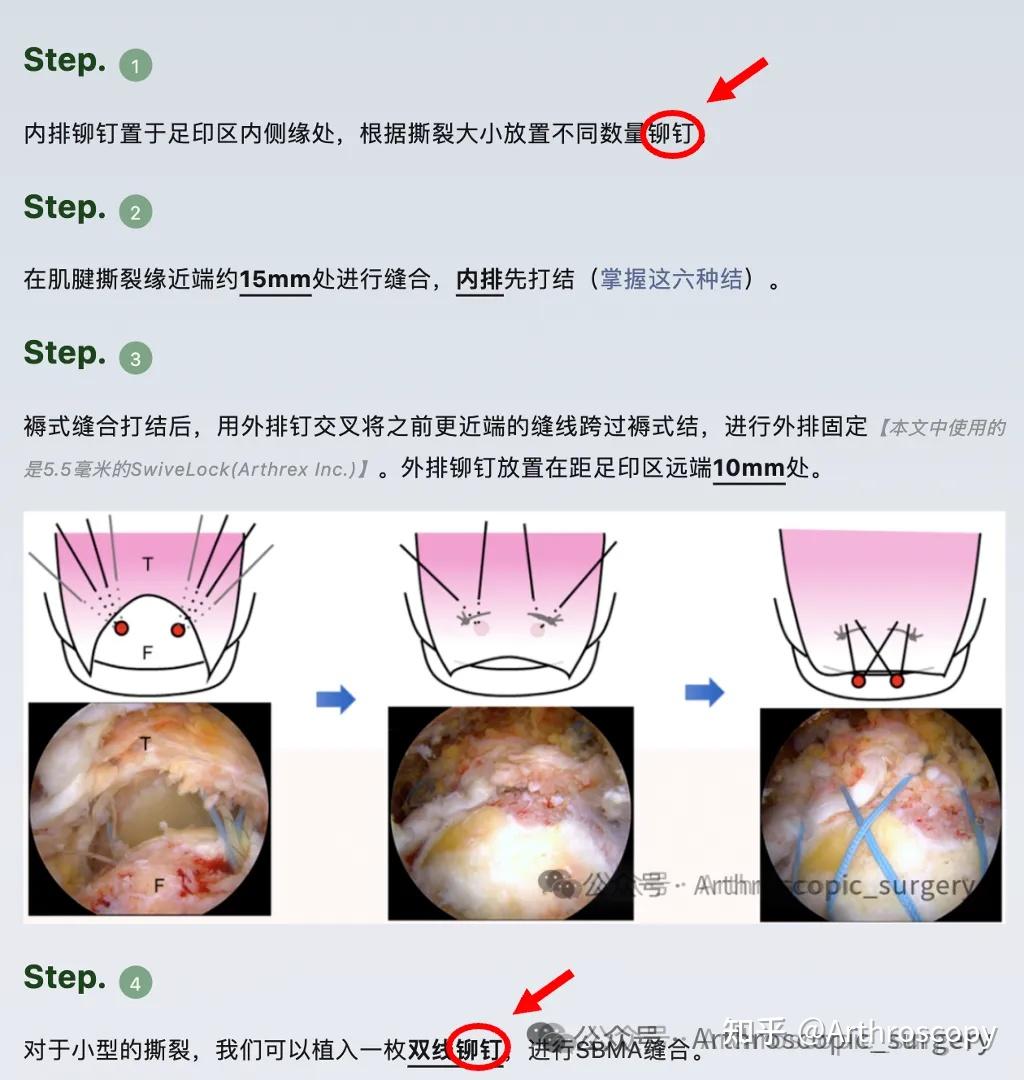 医学科普|铆钉还是锚钉? - 知乎