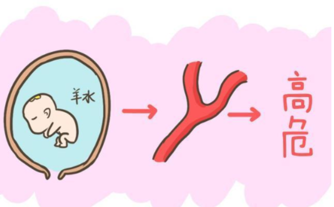 死亡率达到80%的羊水栓塞,你了解吗?