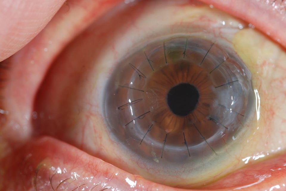 全飞秒激光手术安全吗