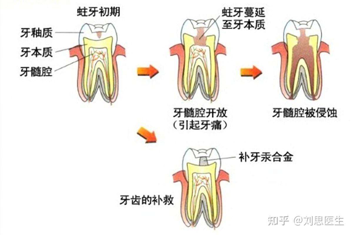 急性牙髓炎是如何引起的-京东健康