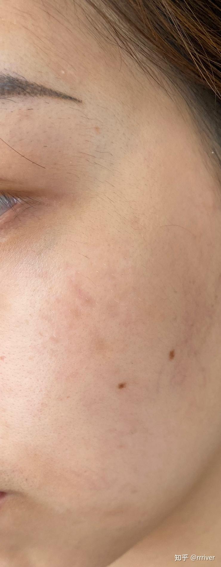 有谁褐青色痣治好过