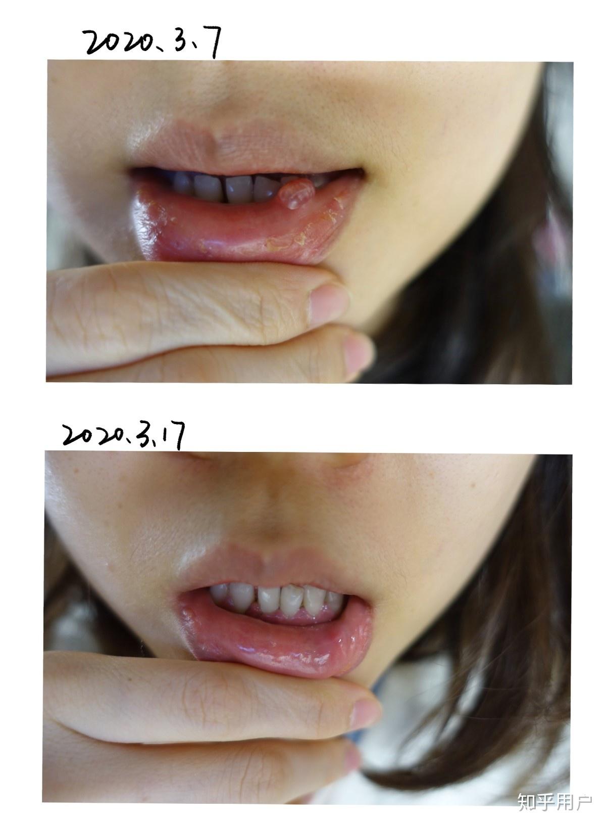 粘液腺肿囊可以自愈吗? - 知乎