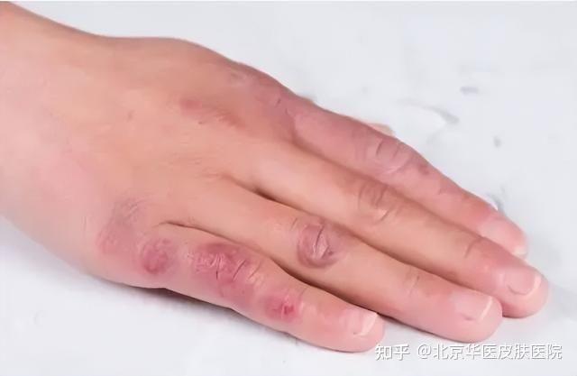 冻疮早期症状有哪些 - 知乎