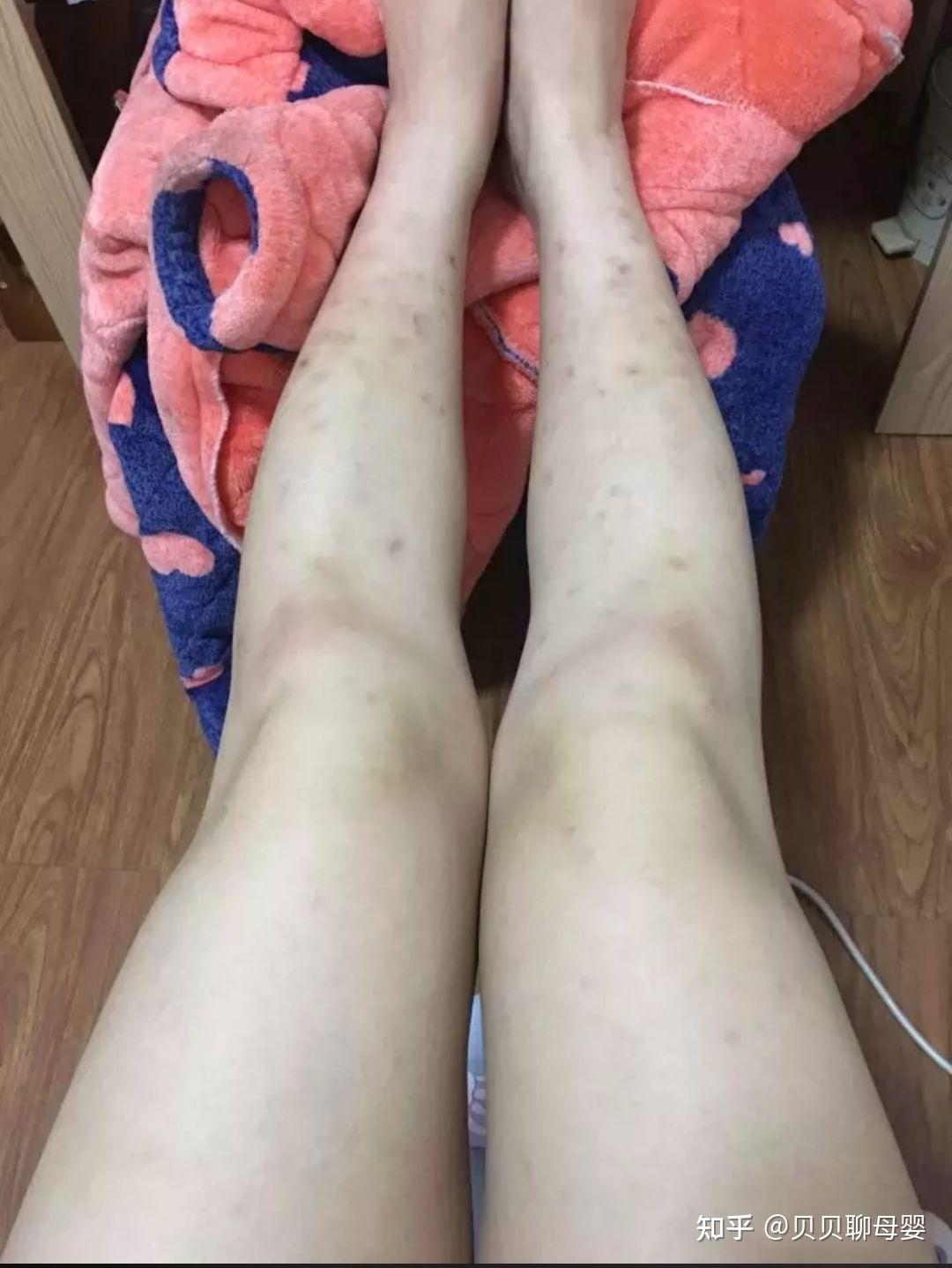 夏天蚊子在腿上咬的疙瘩,留下的疤痕,该怎么祛除? - 知乎