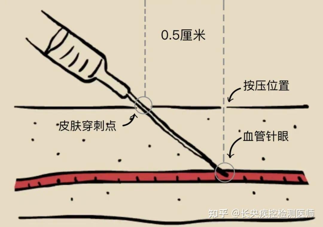 做皮试没换针头会感染艾滋吗?