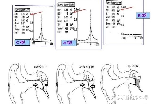 鼓室图分型及其意义图片