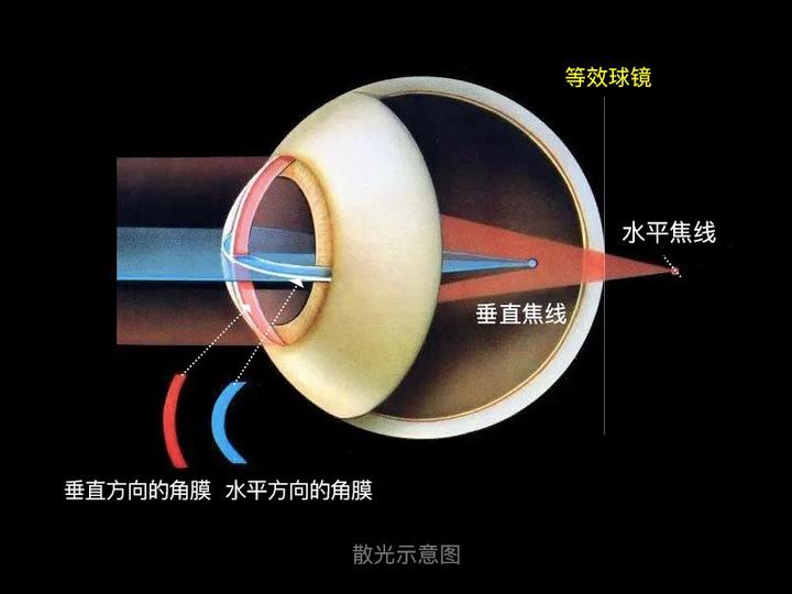 散光形成原因，看这一篇就够了 - 知乎