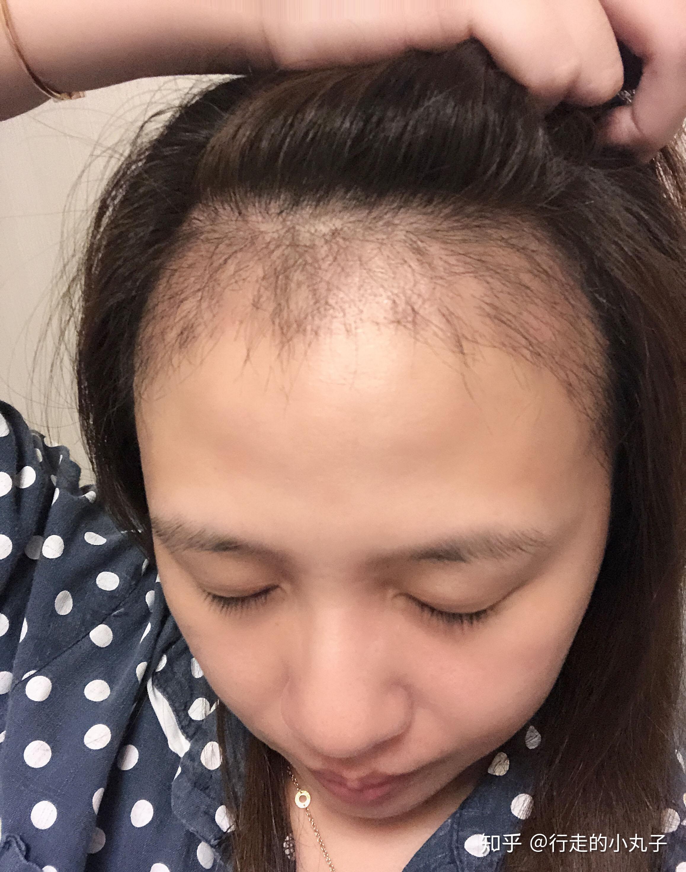 女生m型脱发是不是除了植发没别的办法了