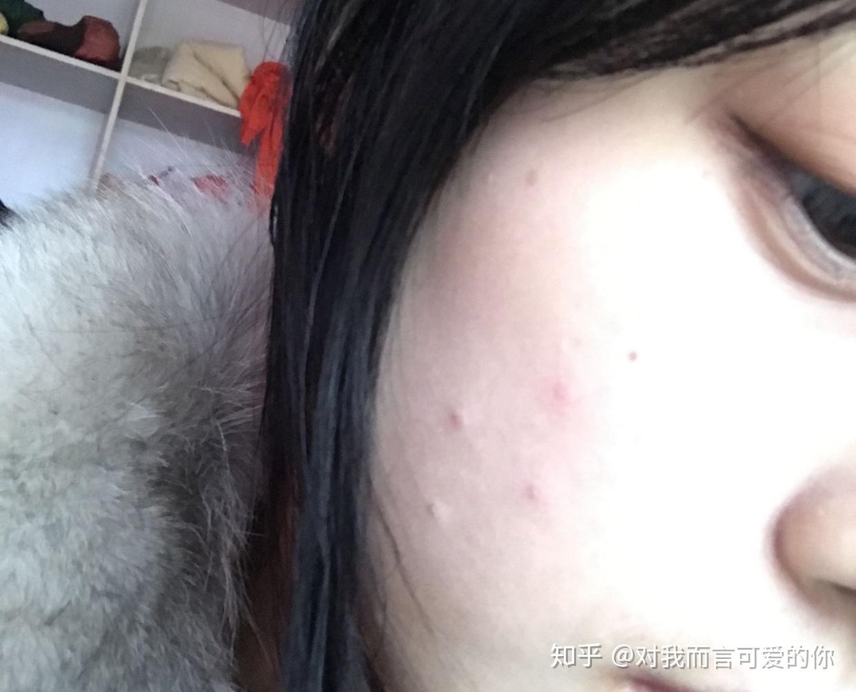 人得了猫癣怎么治疗啊急