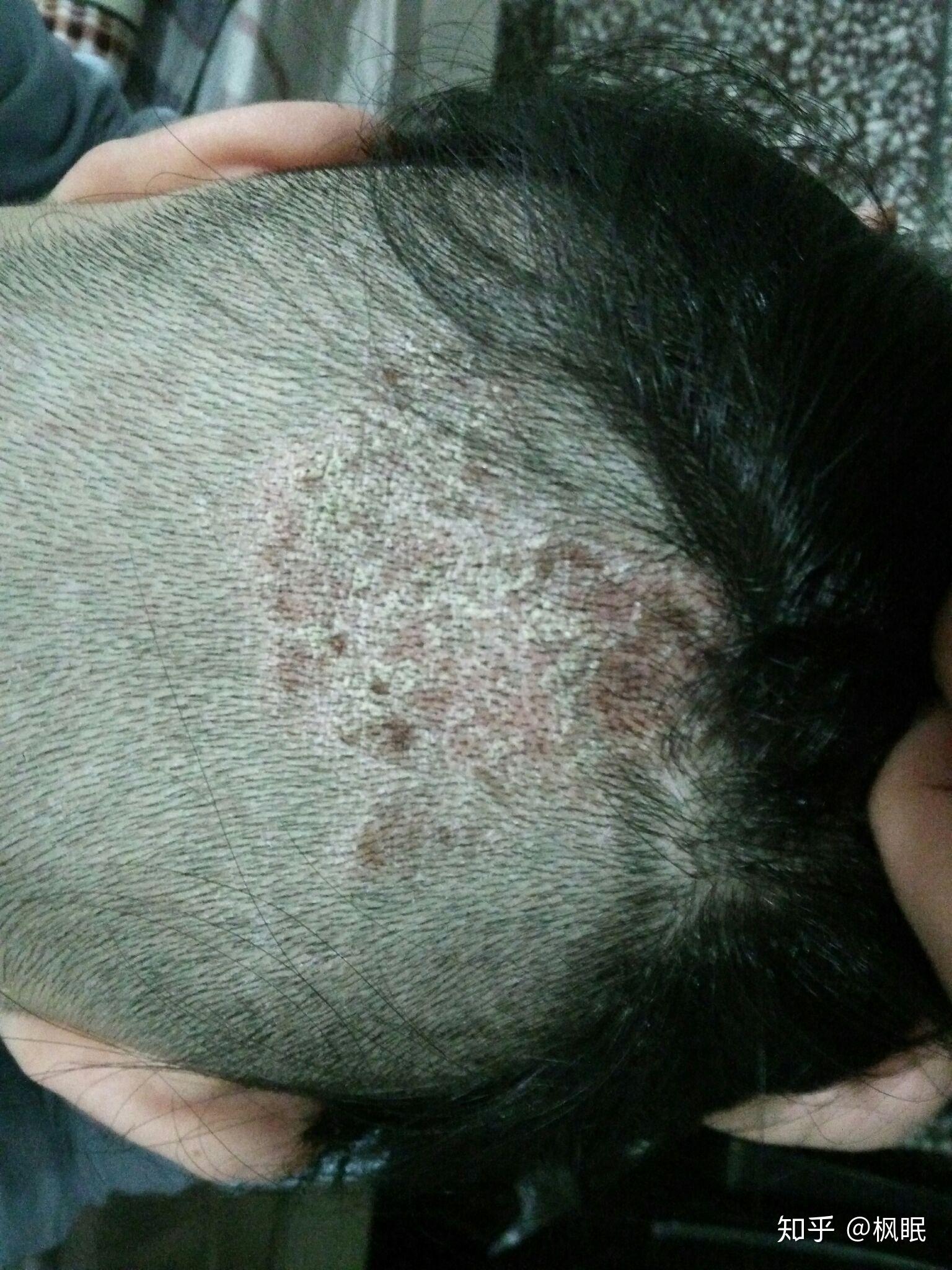 头部脂溢性皮炎的治愈过程? - 知乎