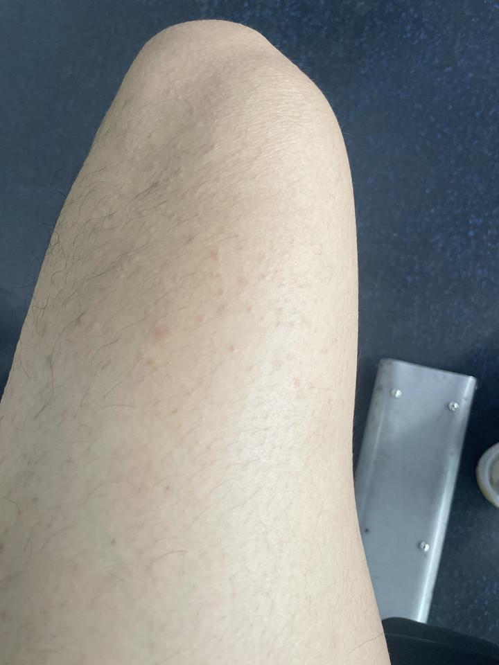 大腿内侧有好多小疙瘩如图