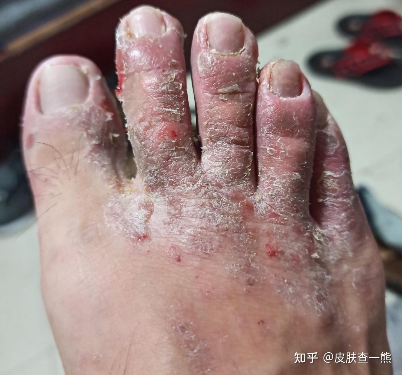 糜烂型脚气需要注意什么? - 知乎