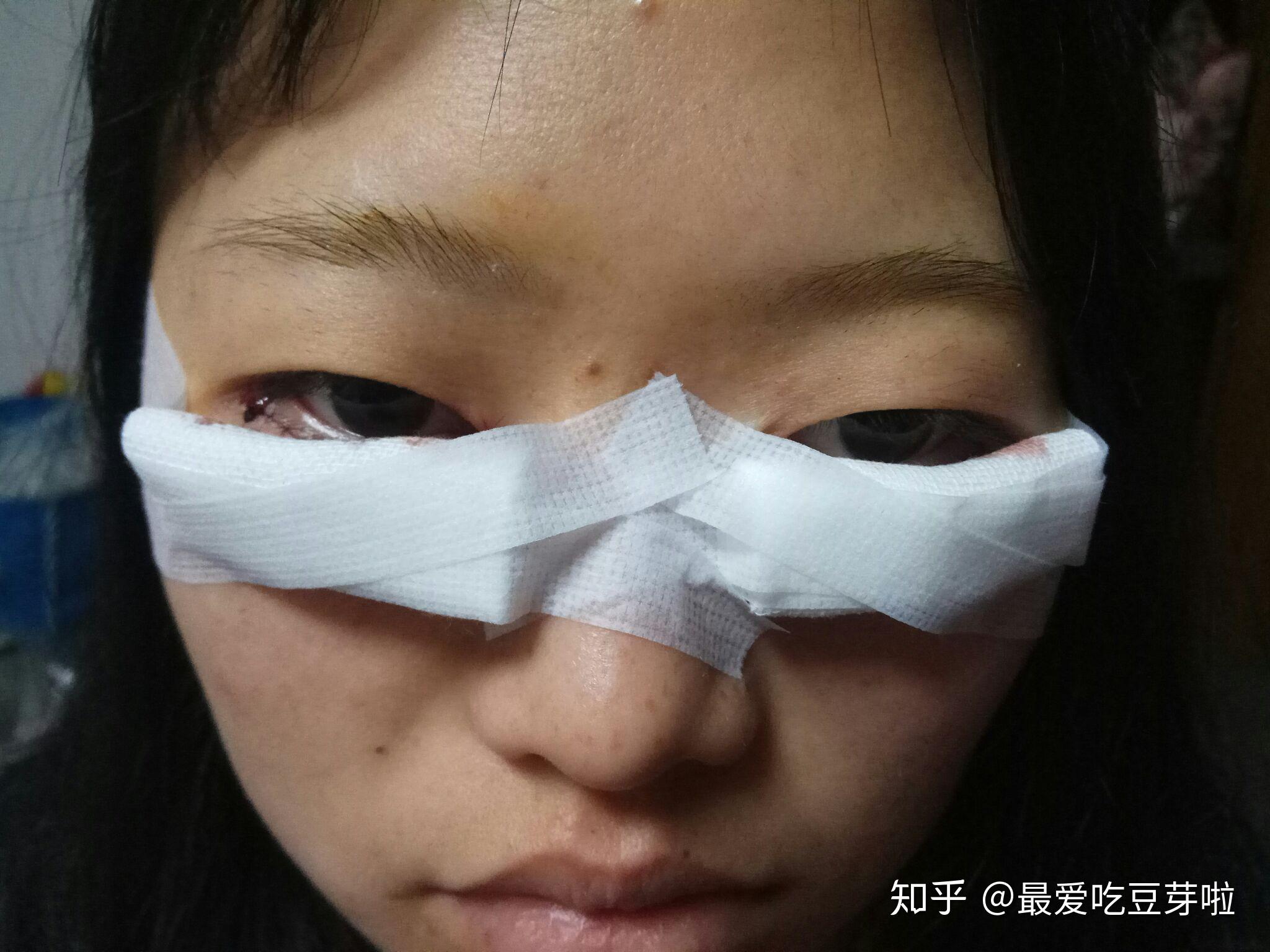 下睫毛倒睫 做完手术会是什么样子,对以后割双眼皮有影响吗 ?