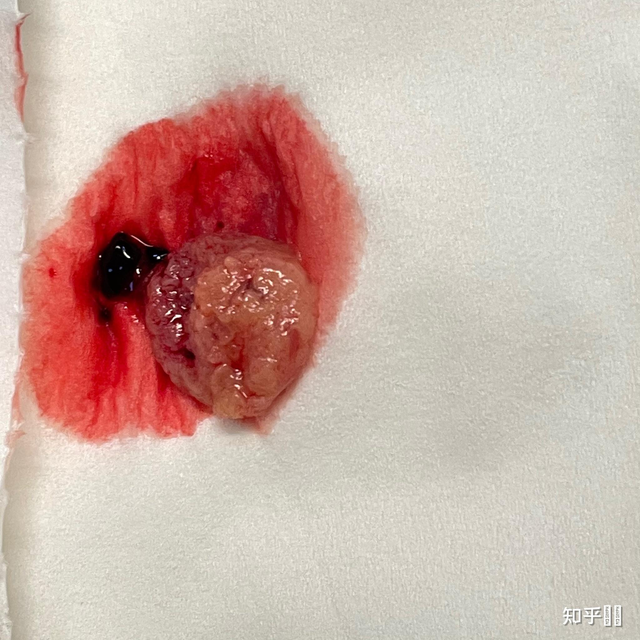 药流后一定需要清宫吗? - 知乎