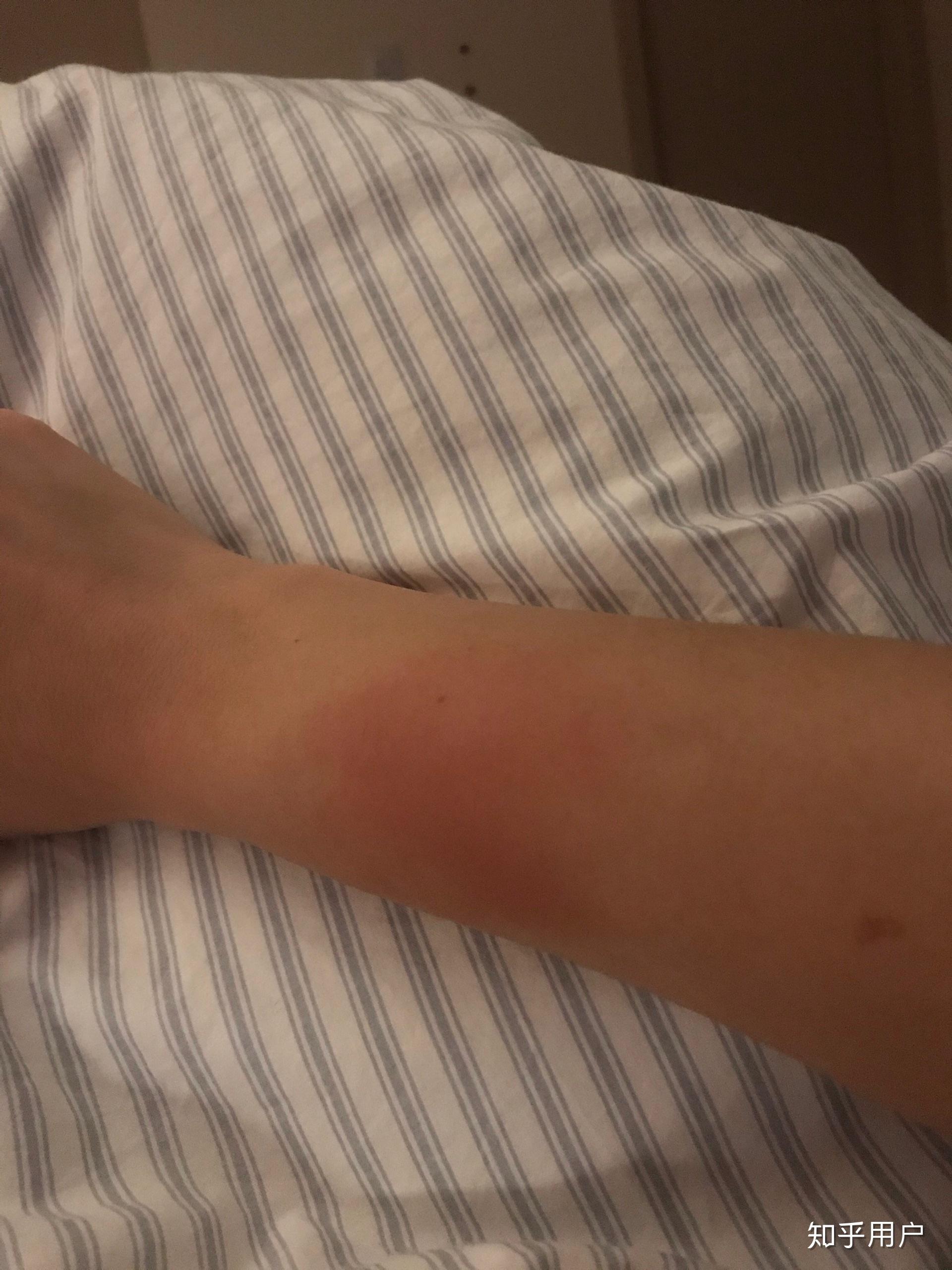 为什么手臂莫名疼痛红肿特别是旋转时疼痛难忍