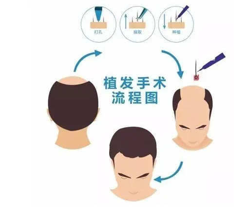 植发有年龄要求吗？植发哪里好？ - 知乎