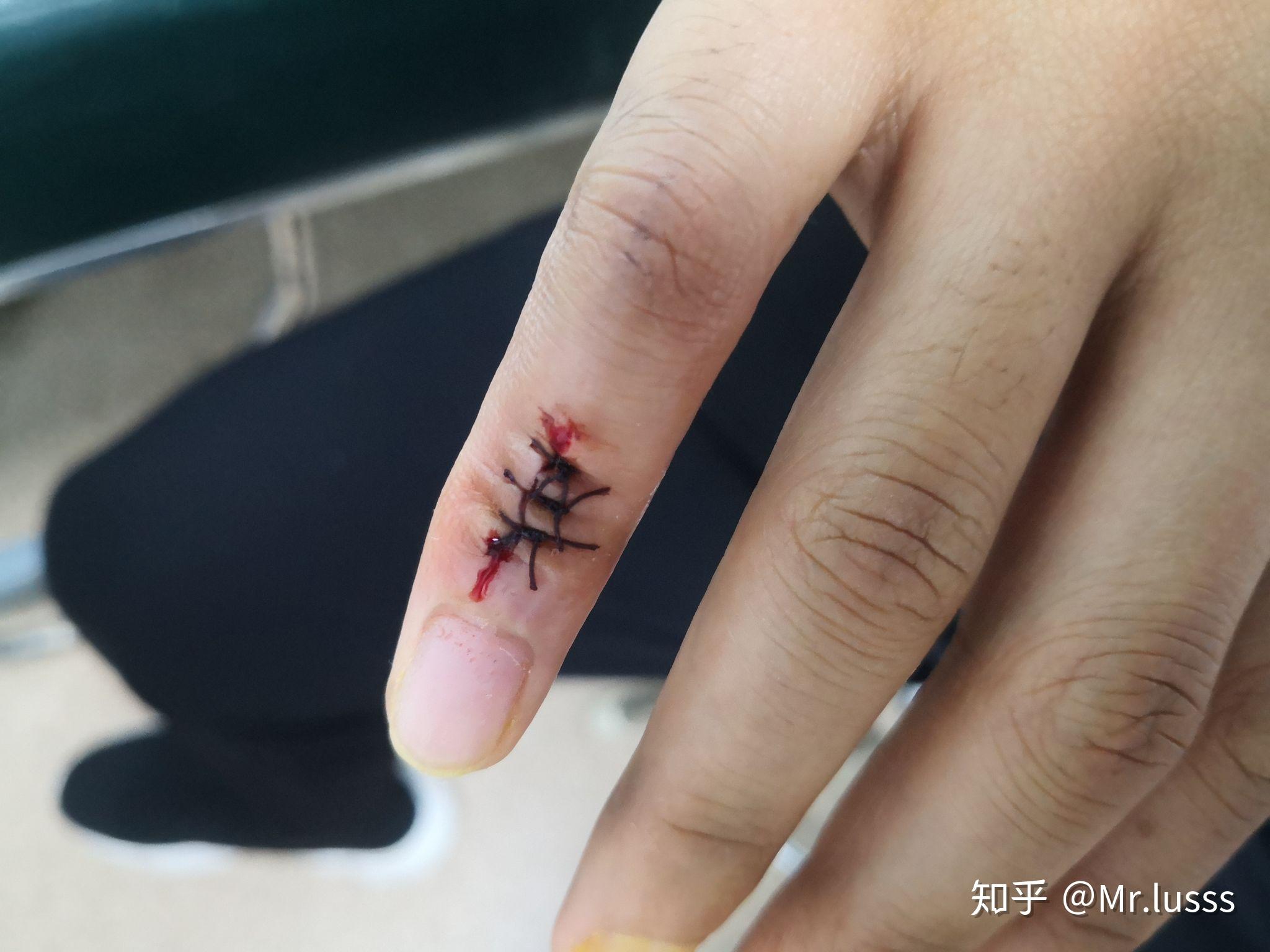 打篮球时手指戳伤不能伸直,求有经验的大神告诉我这是否严重啊!