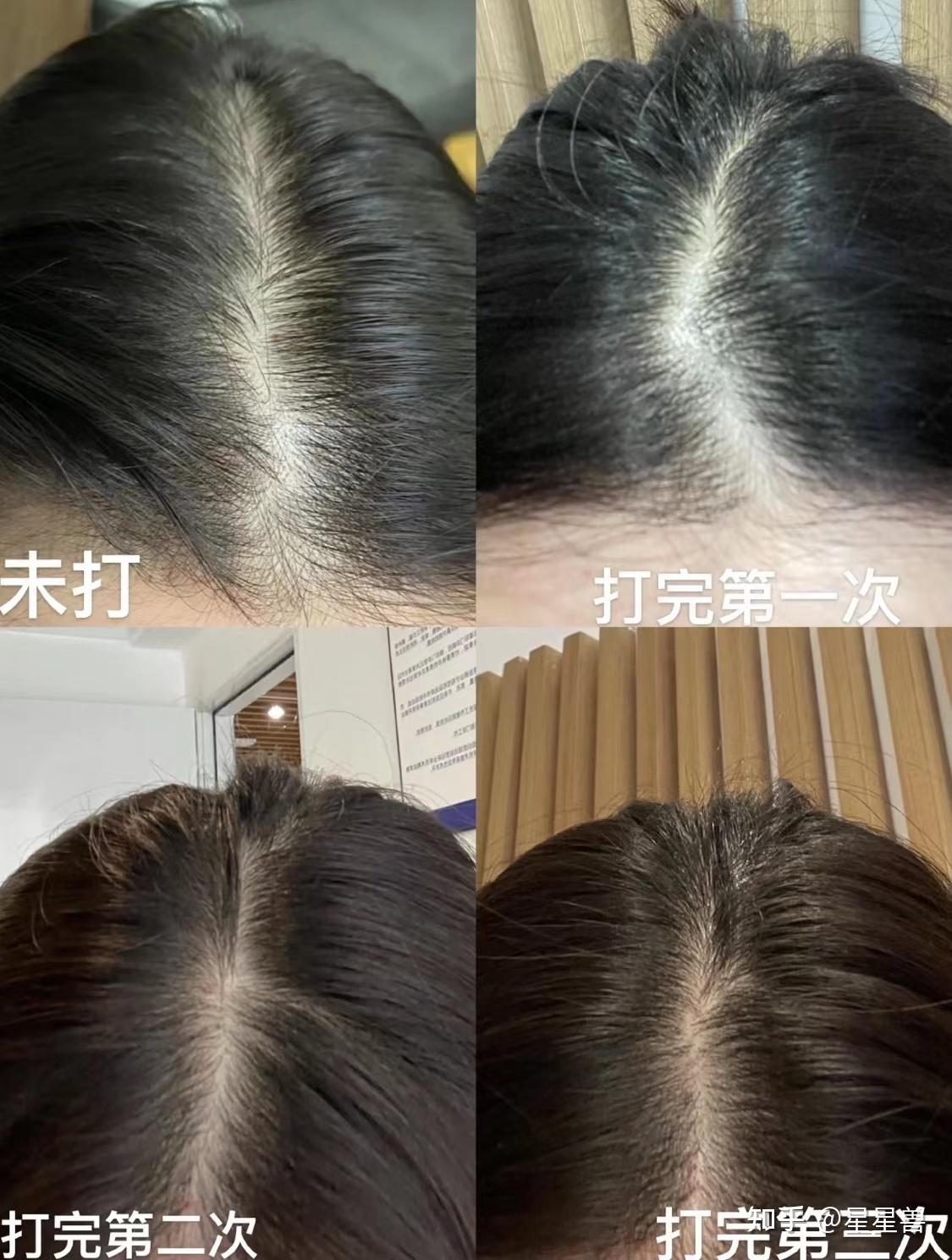 熬夜造成的脱发能不能恢复