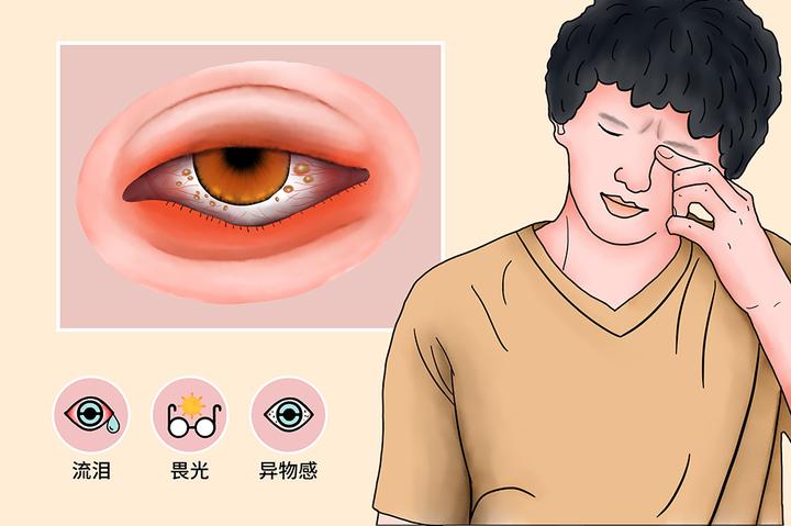 眼睛反复又红又痒,千万不要乱揉,小心结膜炎找上你 - 知乎
