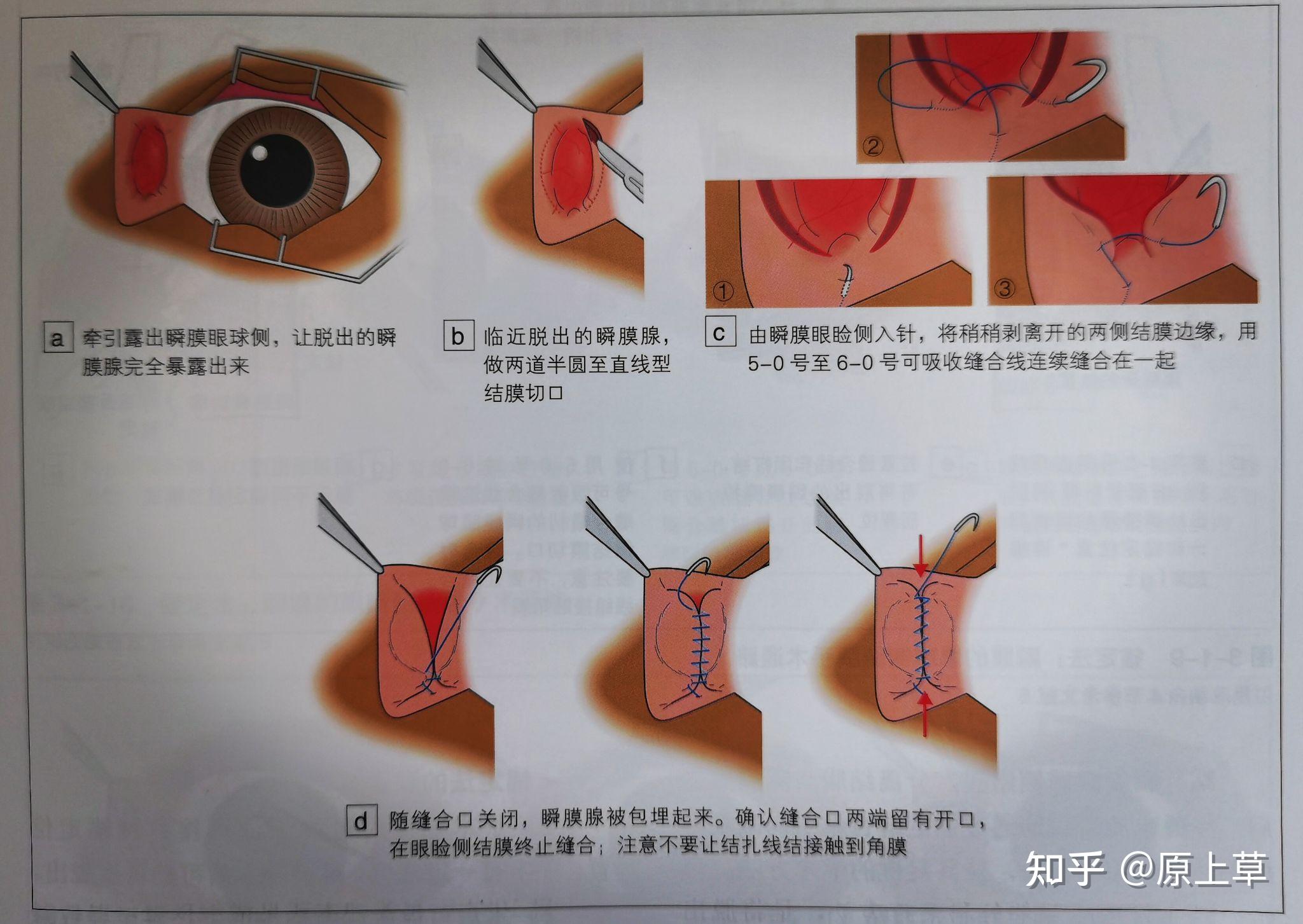 第三眼睑切除术图解图片