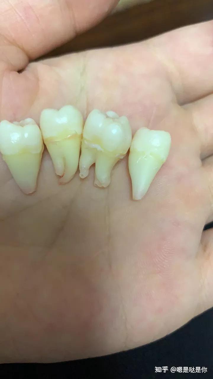 长四颗智齿,均匀分布上下左右,一次次拔牙会不会很受罪?