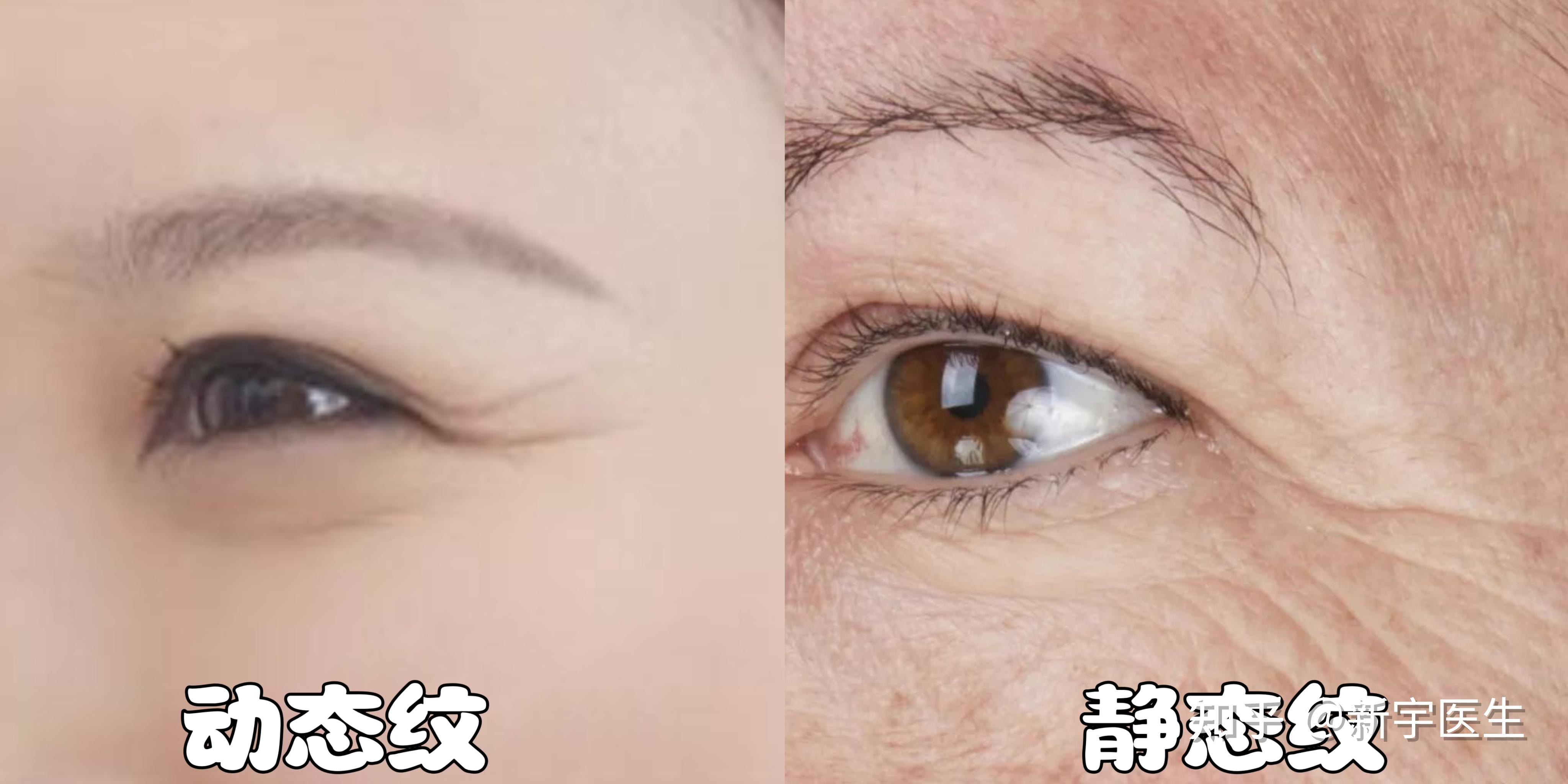 怎么淡化眼部细纹? - 知乎