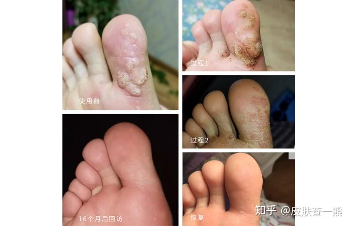 患过趾疣的进大家说说自己的书怎么治好的