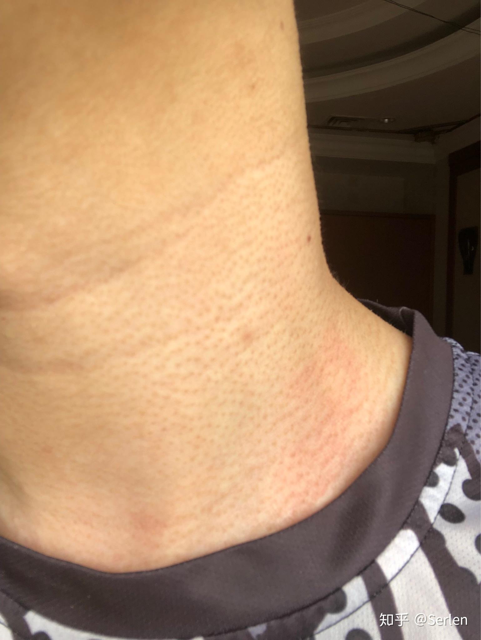 脖子上长的像鸡皮的是什么
