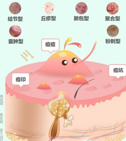 丘疹型痘痘要多久才能自愈?