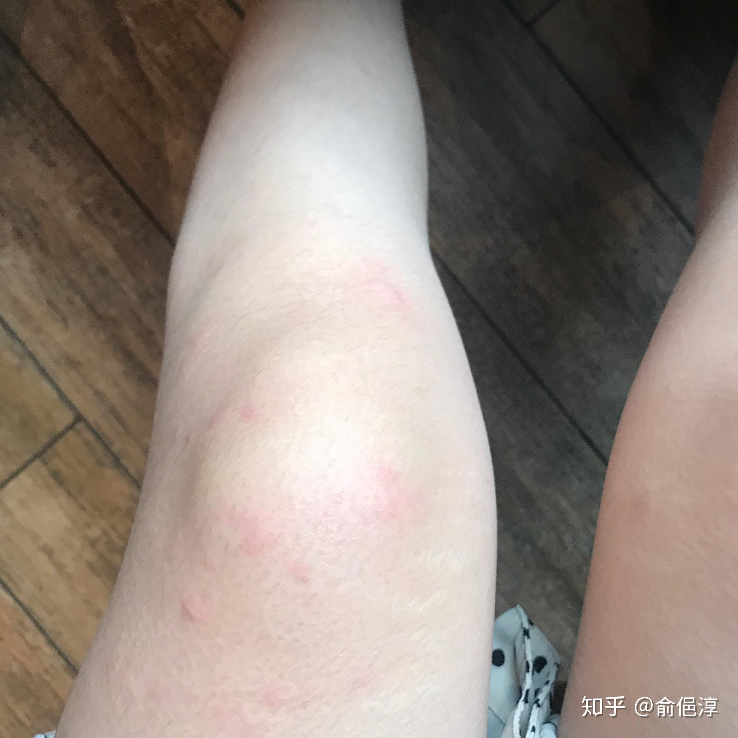 又到了寒冷性荨麻疹肆虐的季节有同道中人吗