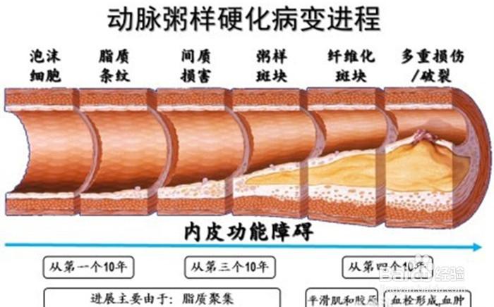 动脉粥样硬化病理变化及造模 - 知乎