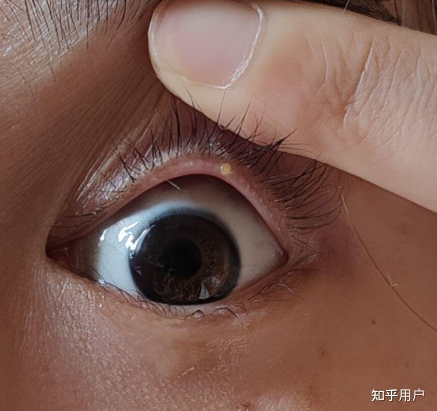 眼睛睫毛根部长疙瘩不痛不痒用手可以扣掉类似痘痘的这是什么